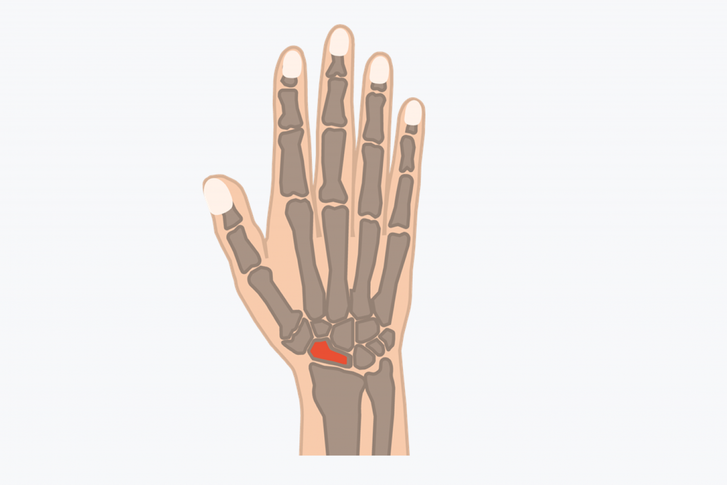 Kahnbeinfraktur: Die 7 wichtigsten Themen bei einem Bruch im Handgelenk