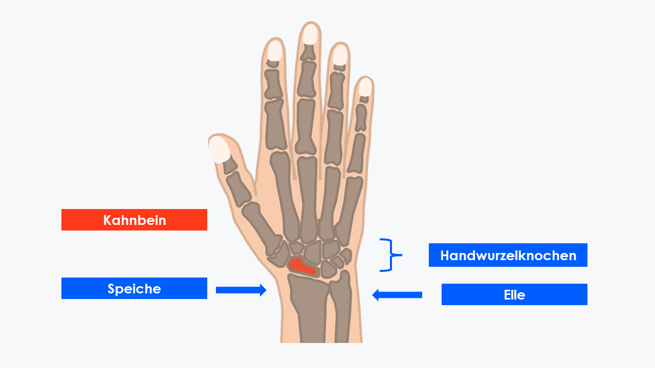 Das Kahnbein (rot) ist der von acht Handwurzelknochen der am häufigsten betroffene Knochen.