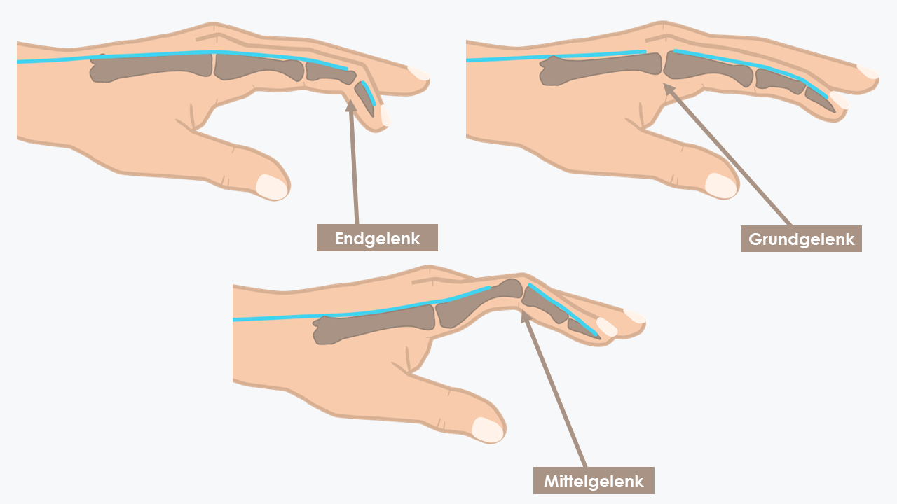 An der Art der Beugung des verletzten Fingers lässt sich oft bereits erkennen, wo die Sehne gerissen ist. 
Hammerfinger (oben rechts), Knopflockdeformität (unten), Verletzung am Grundgelenk (oben rechts).